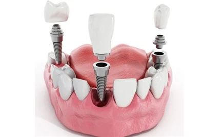 Hoeveel tanden kunnen tandheelkundige implantaten vervangen?|Populaire wetens...